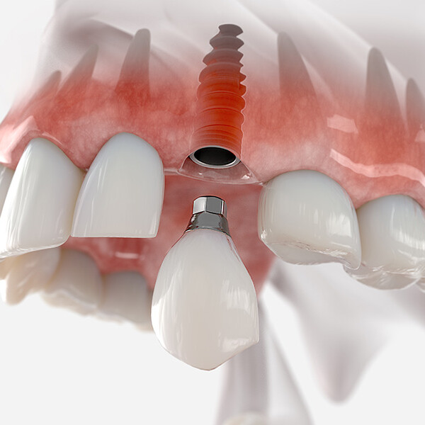 Implants