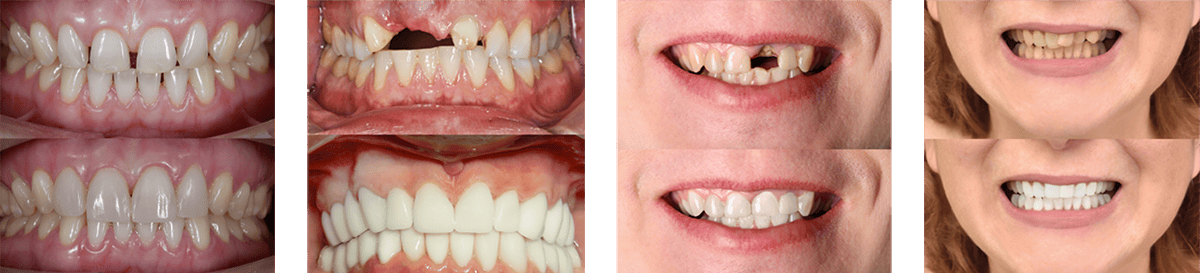 Teeth Gallery single