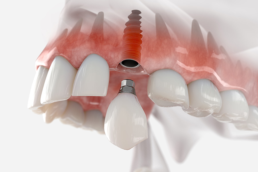 Implants