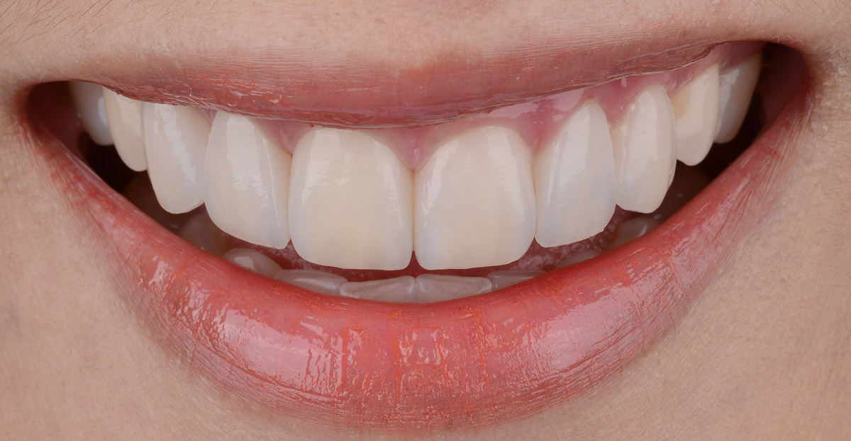 Invisalign after 01