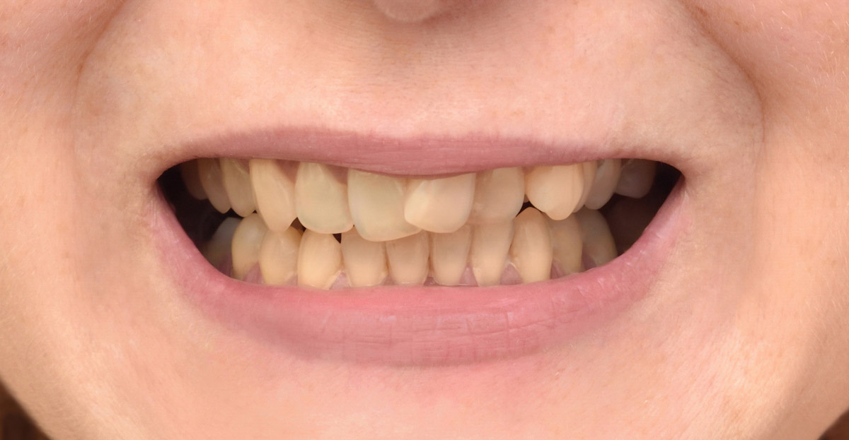Invisalign before 03