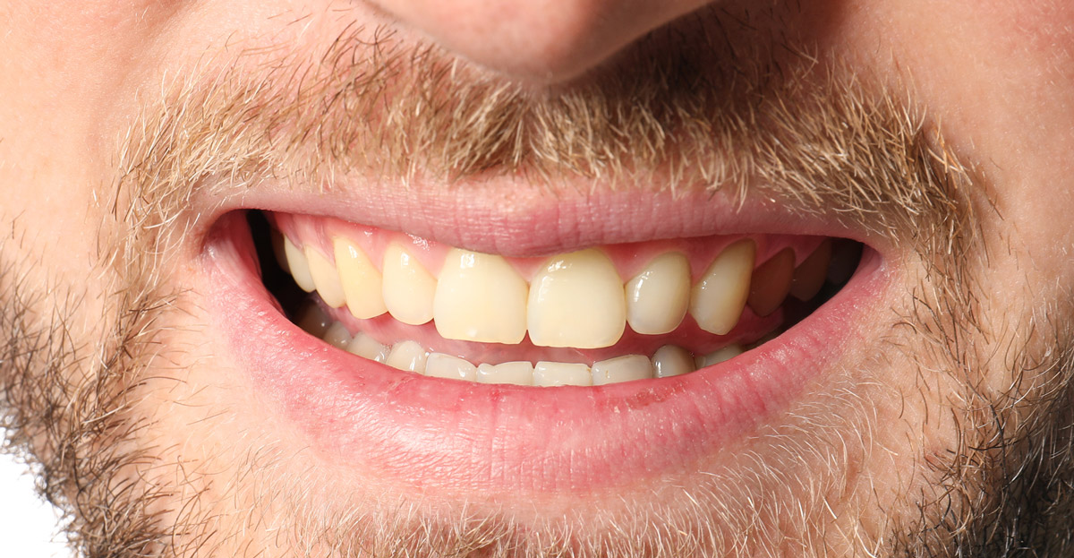 Teeth Whitening Before 02